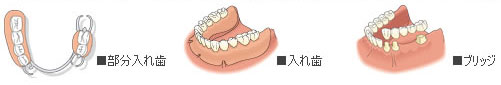 歯を失って悩むこと