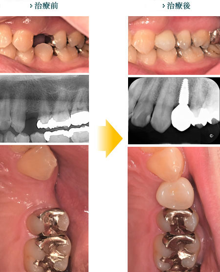 インプラント治療の目的