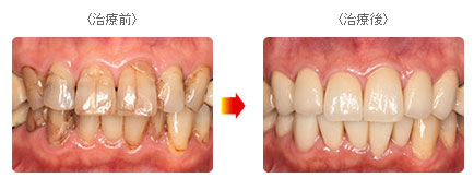 セラミッククラウン症例